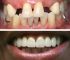 670ef7358276b02e77f514c7_case-02-bridges-implants.webp